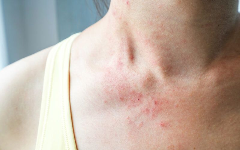 екскориация разстройство бране на кожата