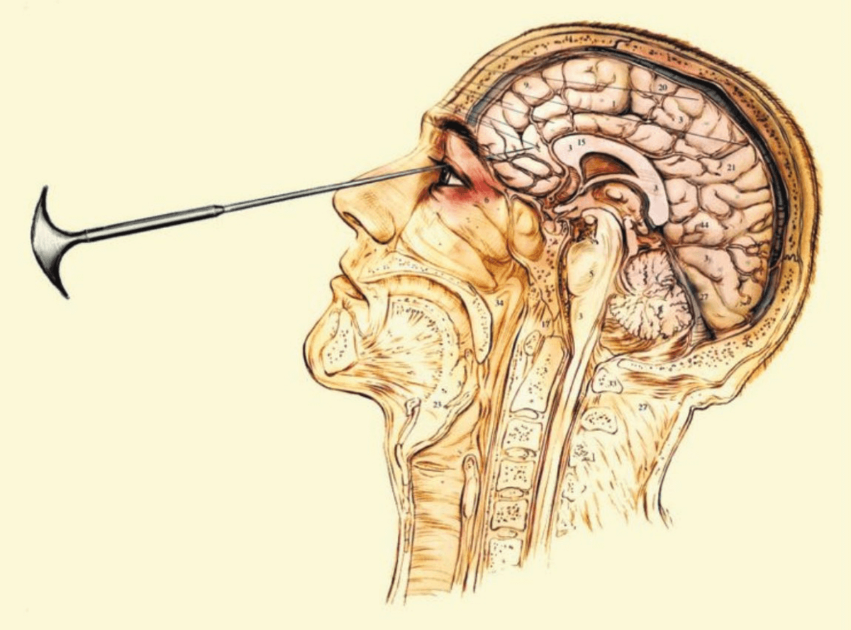 dijagram mozga lobotomije